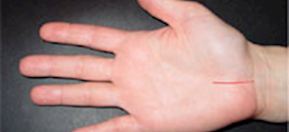 Carpal Tunnel Syndrome